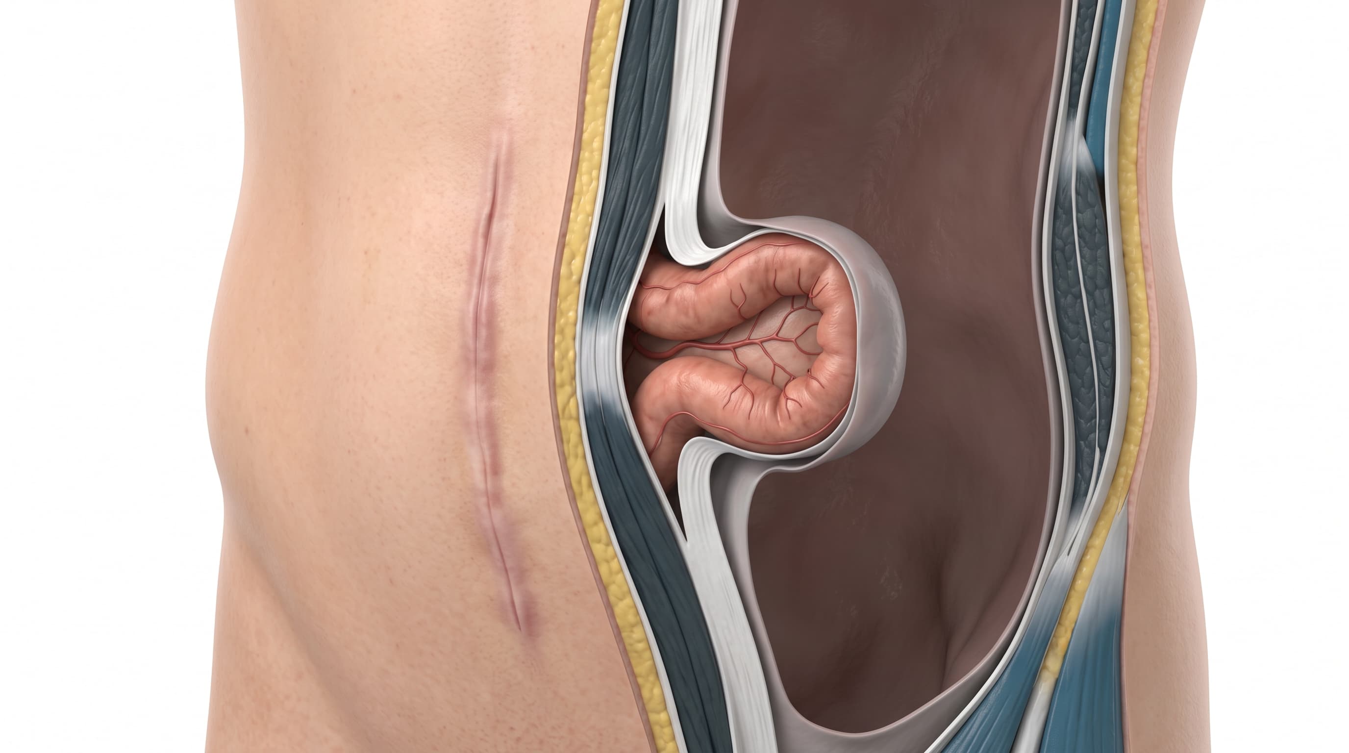 Hernia Incisional (Eventración)