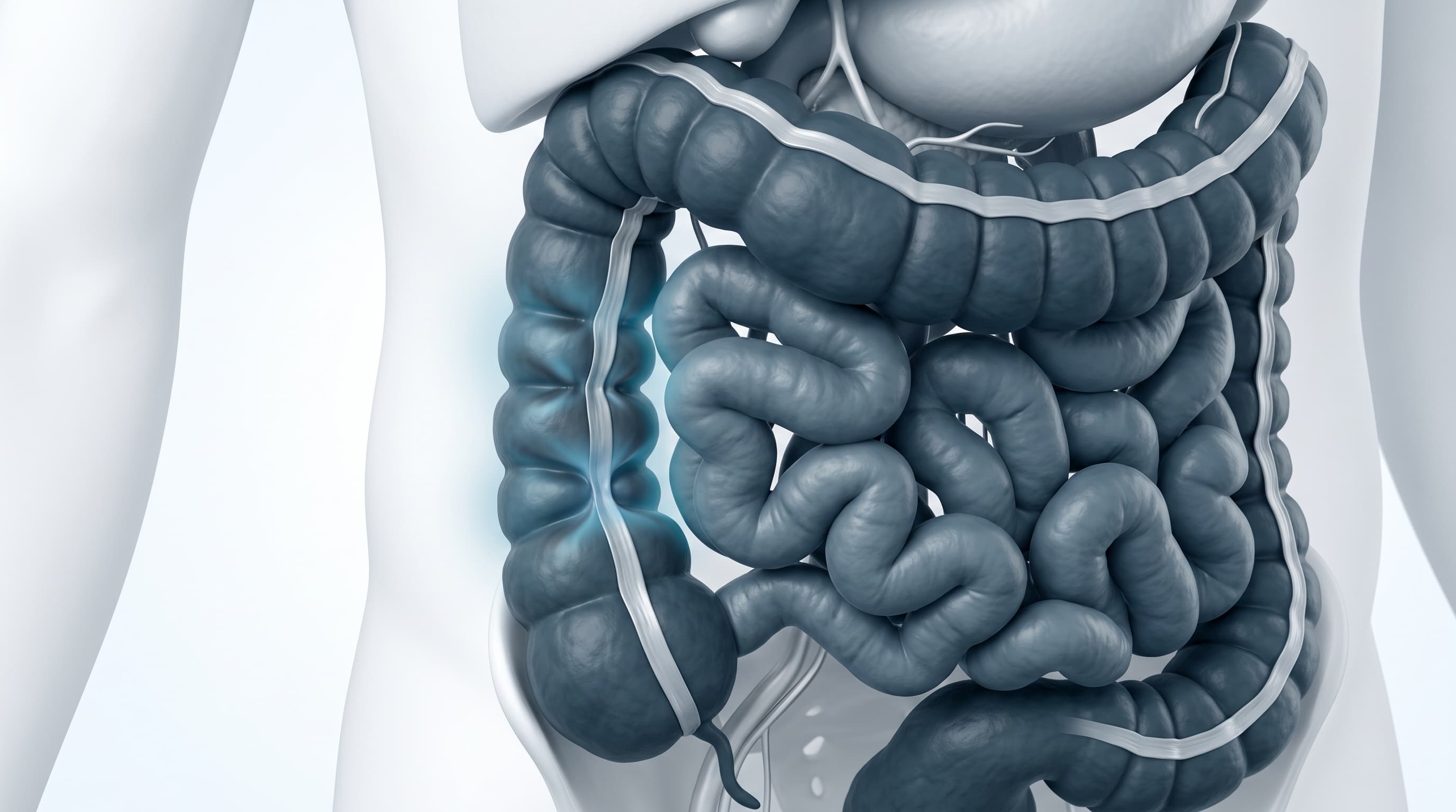 Colitis y Síndrome de Intestino Irritable